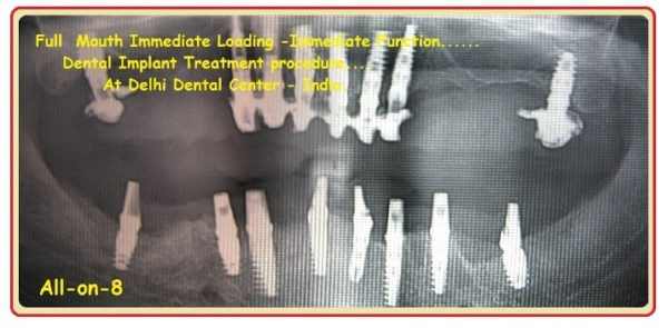 Cost or price of all-on-8 treatment procedure by Dentist Clinic abroad ...