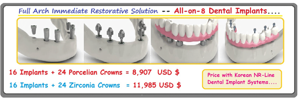 All on 8 Dental Implant Treatment in India