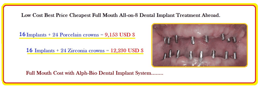 All on 8 Dental Implant Treatment in India