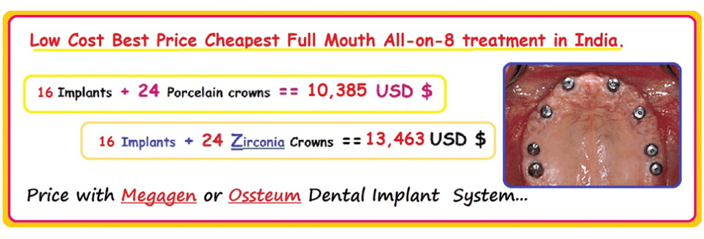 All on 8 Dental Implant Treatment in India