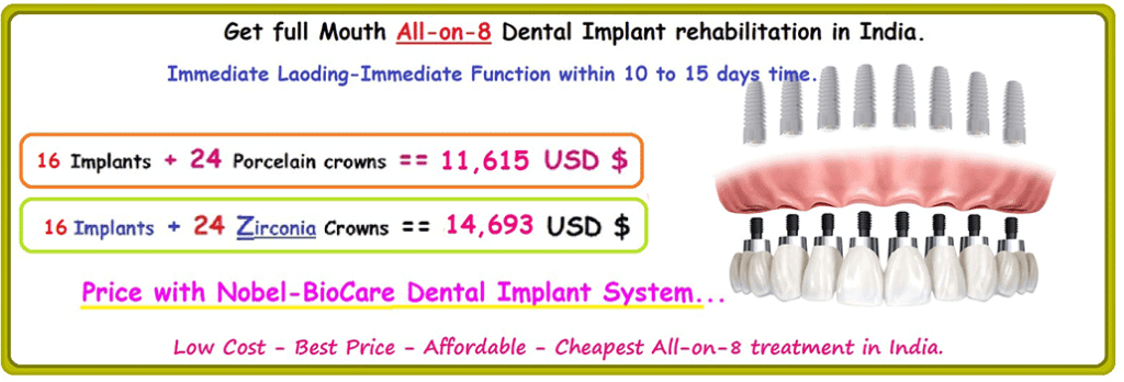 All on 8 Dental Implant Treatment in India