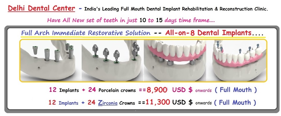 full-mouth-all-on-8-dental-implant-price-cost-Delhi-Inida-Banner - Copy